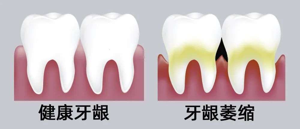 牙縫大露出“黑三角”，既塞牙又難看！還能恢復(fù)嗎？